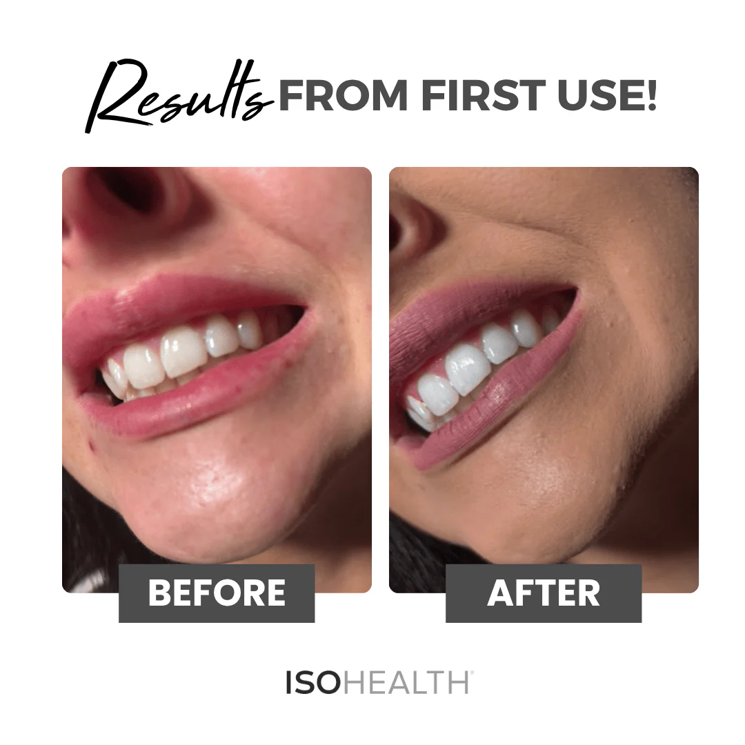 ISOHEALTH Teeth Whitening Strips (28 strips) Available In Clear Or Carbon - Image 4
